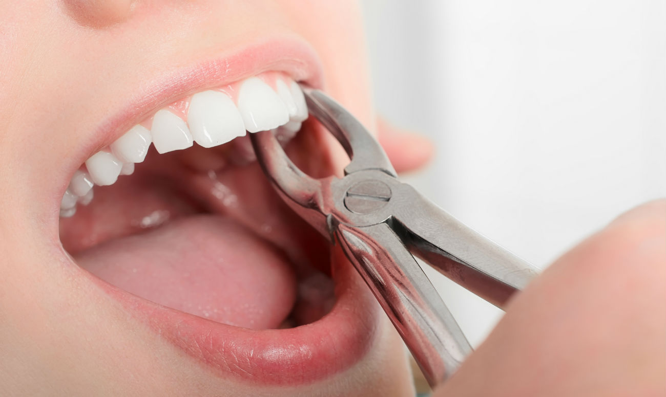 После удаления молочного зуба: принципы ухода